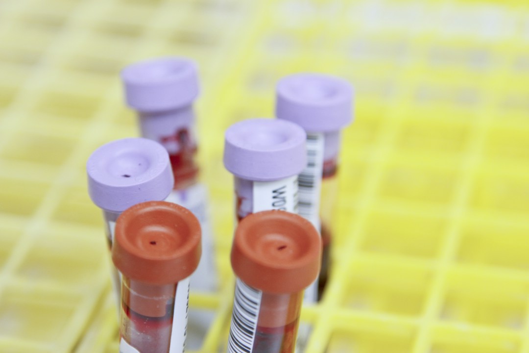 CRP élevée : comprendre votre analyse sanguine